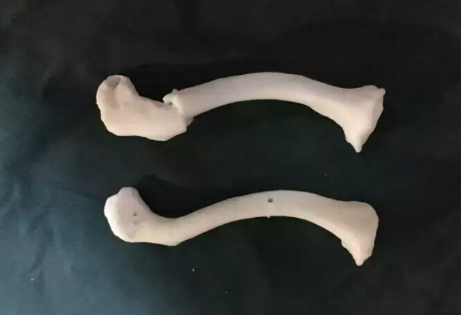 3D打印“鏡像”模型輔助設(shè)計(jì)下微創(chuàng)治療鎖骨骨折